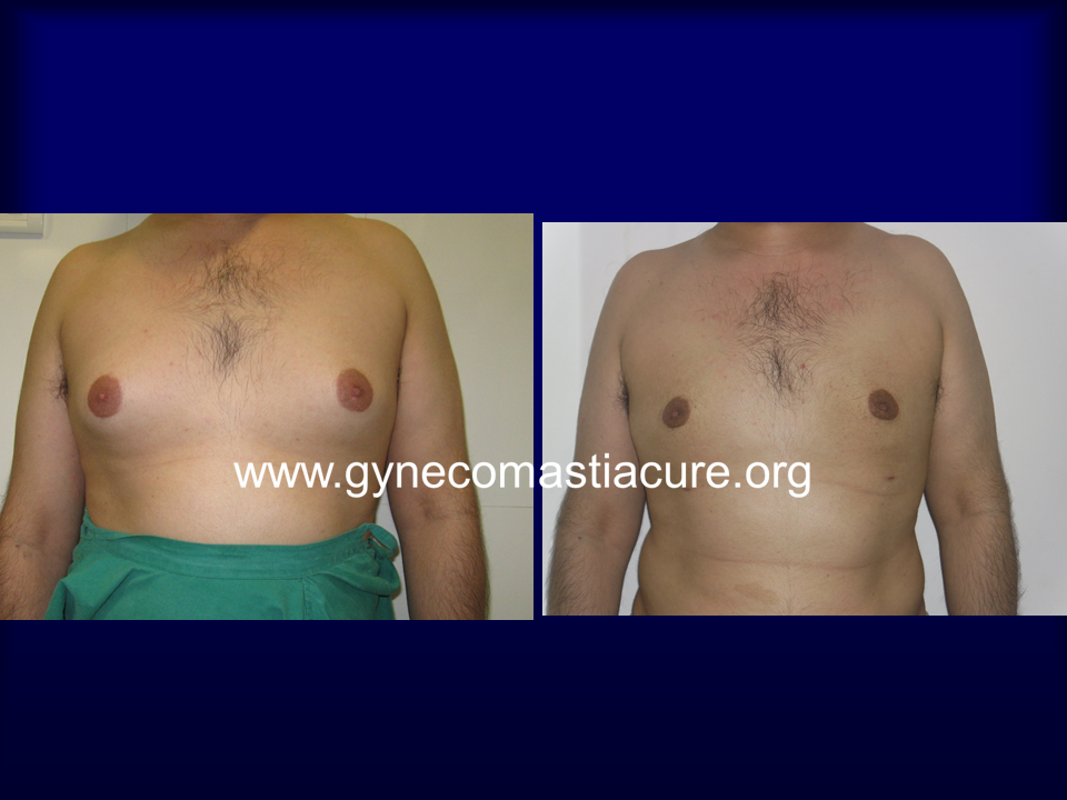 Before And After Gynecomastia Surgery