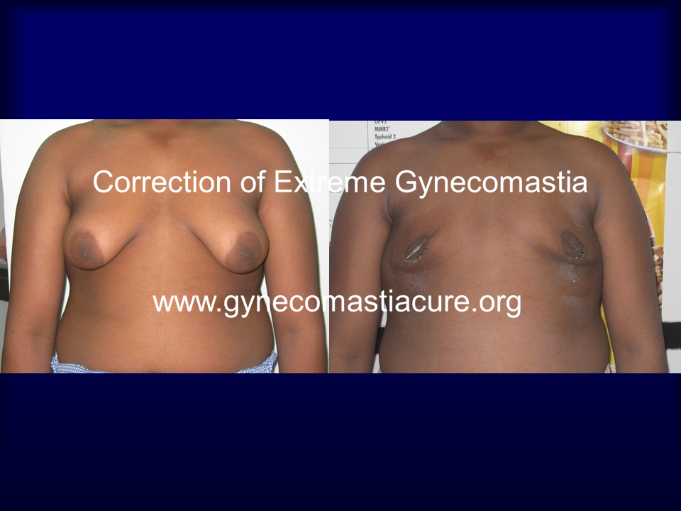 Extreme Gynecomastia Treatment